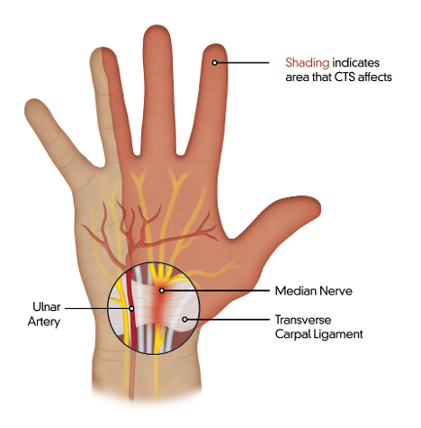Ultraguide Carpal Tunnel Release